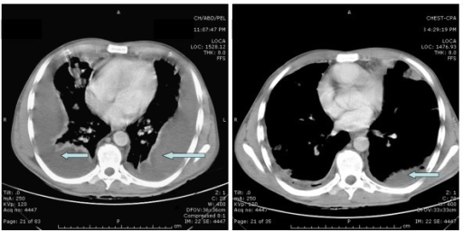 CT scans of the chest. Left: Computed Tomography scan o ...