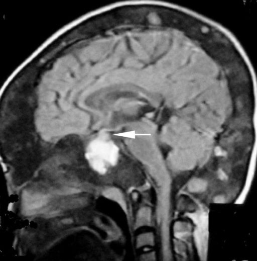T1-weighted coronal MRI scans of the head. Normal pitui | Open-i