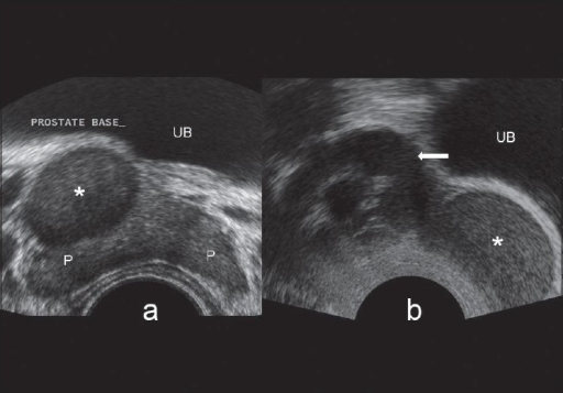 A Trans Rectal Ultrasound Transverse Image Showing A Open I