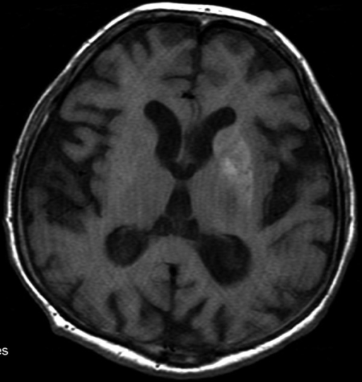 The MRI performed 4 days later. SE/T1 – Hyperintense | Open-i