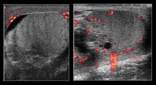 Doppler Ultrasound Of Bilateral Testes Shows Swollen Ri Open I 8643