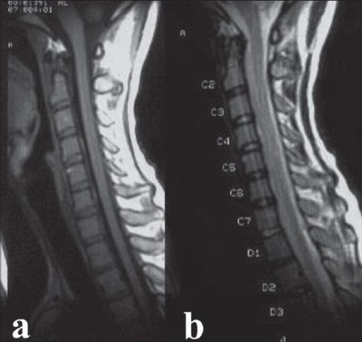 Mid Sagittal T1 A And T2 B Weighted Mri Of Cervic Open I