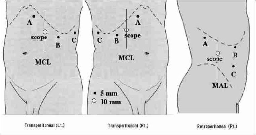 Trocar positions: 10-mm trocar for the laparoscope. A a | Open-i