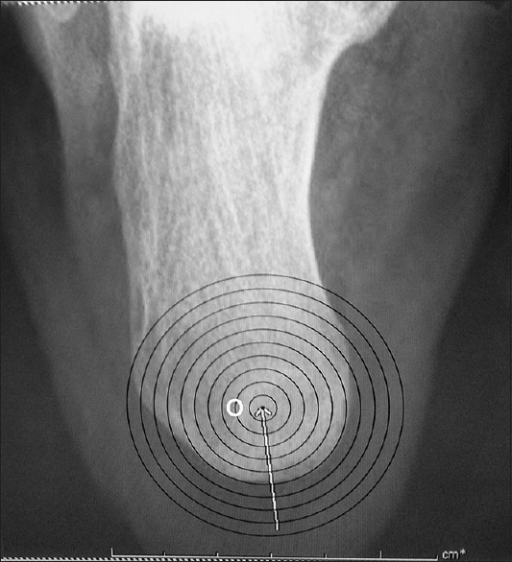 X-ray of the heel in axial view | MyFootShop.com