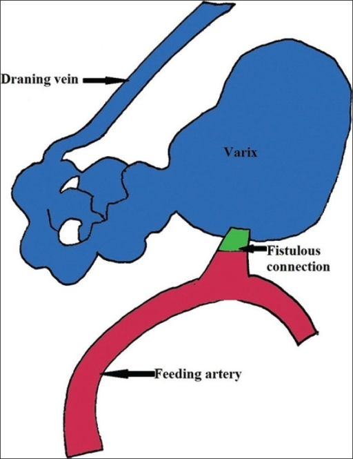 Schematic diagram of pial arteriovenous fistulas compos | Open-i