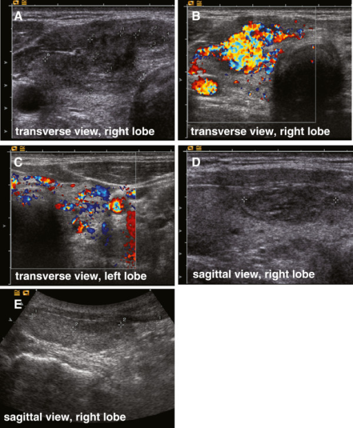 Hot nodule thyroid