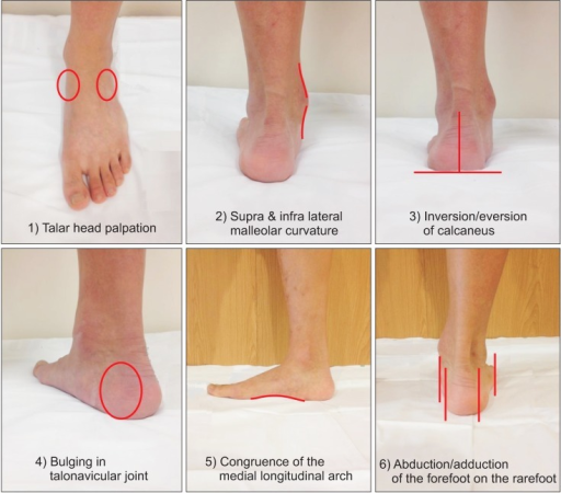 The Six Items Of The Foot Posture Index Open i the-six-items-of-the-foot-posture-index-open-i