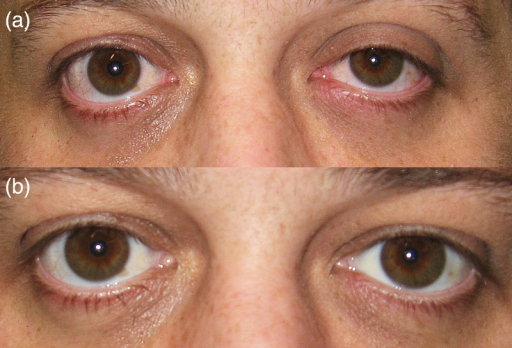 drops for ptosis
