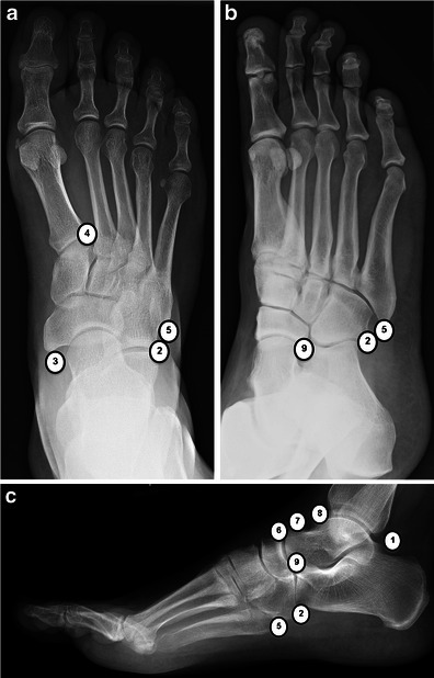 Accessory ossicles of the foot. AP (a), oblique (b) and | Open-i