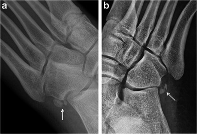 Bipartite versus fractured os peroneum. a Bipartite os | Open-i