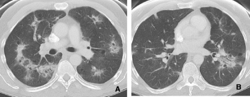 COP. A and B: CT scan shows associated poorly defined n | Open-i