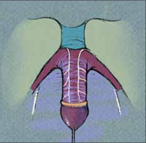 Hypertrophied Clitoris With Dorsal Nerves And Branches Open I 7214