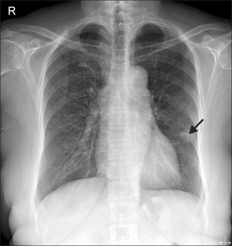 A simple chest X-ray shows a 1.9×1.7 cm hyperdense, ov | Open-i