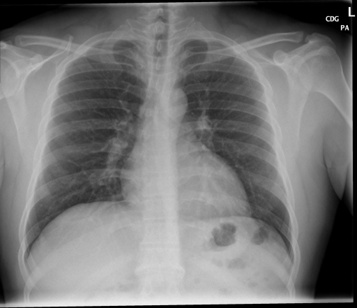 PA and lateral chest XXXX, XXXX XXXX comparison XXXX 10