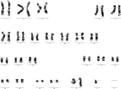 an analysis of chromosome variation in klinefelter syndrome A diagnosis of xyy syndrome is made based upon a thorough clinical evaluation, a detailed patient history, and specialized tests (ie, chromosomal analysis) that detect the presence of an extra y chromosome (47,xyy karyotype. an analysis of chromosome variation in klinefelter syndrome A diagnosis of xyy syndrome is made based upon a thorough clinical evaluation, a detailed patient history, and specialized tests (ie, chromosomal analysis) that detect the presence of an extra y chromosome (47,xyy karyotype.