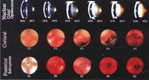 Lens Opacification Classification System Iii Open I