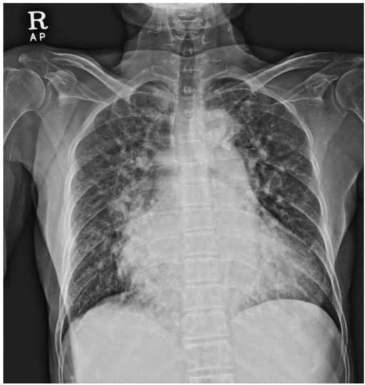 pulmonary-congestion-chest-x-ray