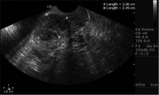 Intrauterine blood clot, Radiology Reference Article