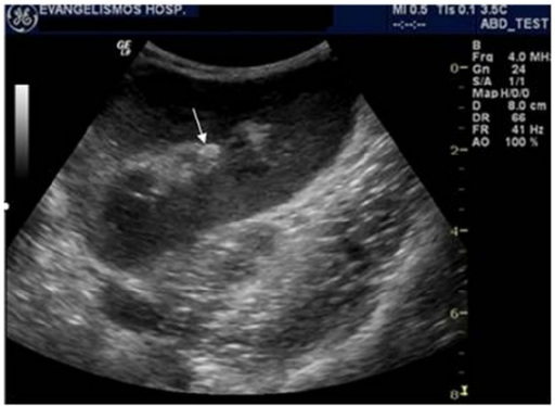 renal-transplant-calculus-ultrasonographic-image-of-a-open-i