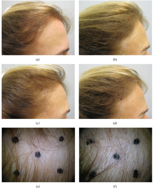 Subject 47 The Number Of Terminal And Vellus Hairs At Open I