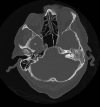 Opacification of the left mastoid air cells in keeping | Open-i