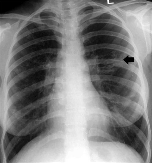 Chest radiograph shows central bronchiectasis (arrow) i | Open-i