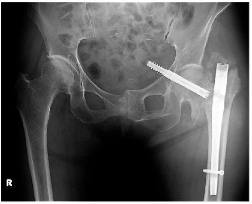 Radiograph showing redisplacement of the fracture and i | Open-i