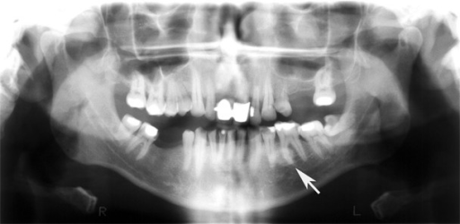 Pantomograph, calculus in the distal segment of the lef | Open-i