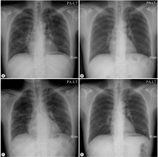 pcp pneumonia chest x ray findings