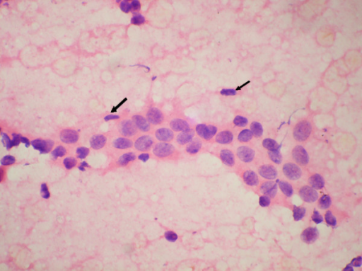 Occasional myoepithelial cells in cytology smear of mod | Open-i