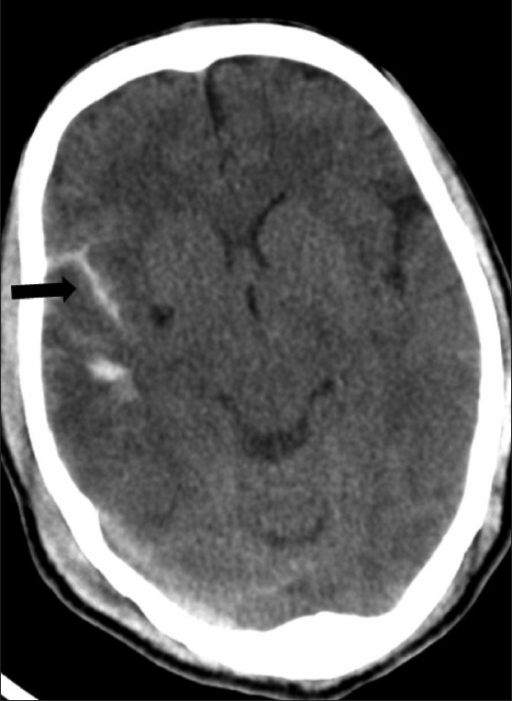 Axial noncontrast CT scan shows a right Sylvian fissure | Open-i