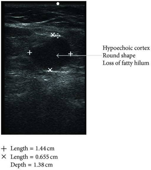 Involved Lymph Node Round Shape Loss Of Fatty Hilum Open I