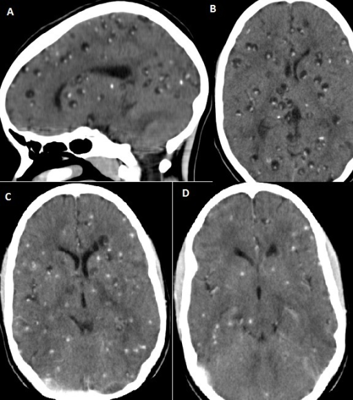 A) Brain CT(Sagittal view) showing Multiple Vesicular C | Open-i