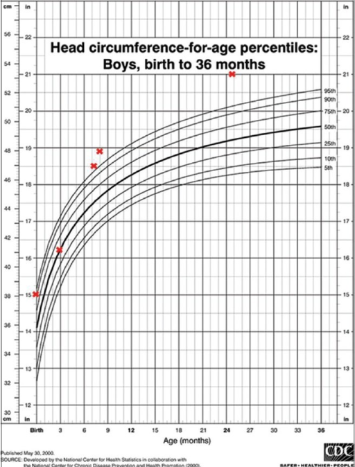 Head circumference chart showing macrocephaly | Open-i