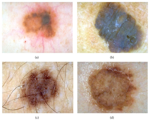 dermatoscopie du mélanome