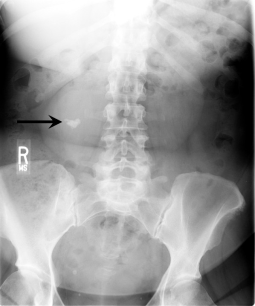 Anterior-posterior view of lumbar X-ray showing a large | Open-i