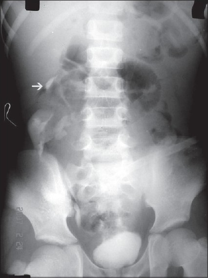 IVU. Arrow pointing to right kidney | Open-i