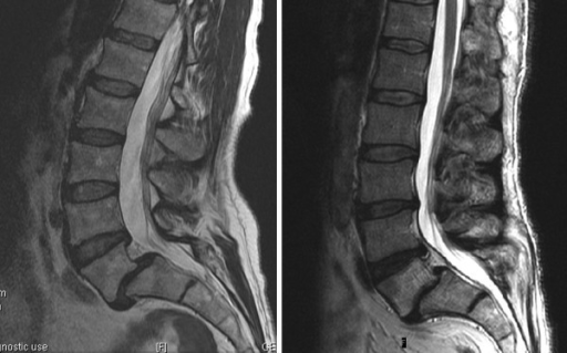 L5 retrolisthesis