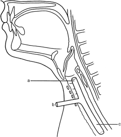 Montgomery T-Tube, schematic drawing of correct positio | Open-i