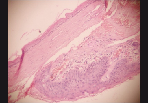 a: Cystic lumen lined by stratified squamous non-keratinized