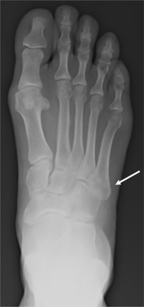 radiography-of-right-foot-revealing-a-well-healing-fift-open-i