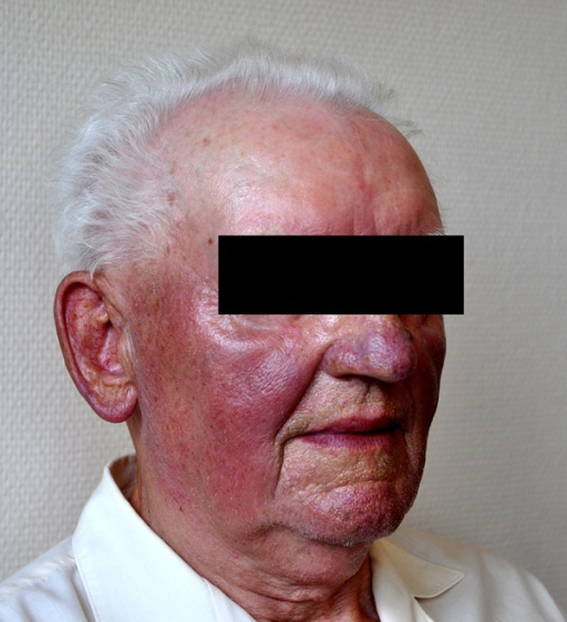 Amiodarone Induced Blue Gray Pigmentation Oci Open I Amiodarone Induced Blue Gray Pigmentation Ociated With Diffuse Erythema In 81 Year
