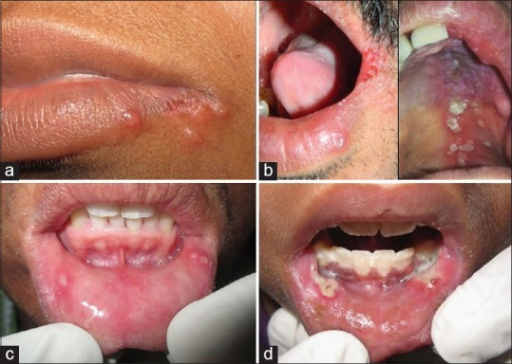 A Acute Outbreak Of Clusters Of Herpetic Vesicles B Open I