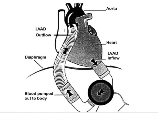 Diagram showing the LVAD and its inflow and outflow con | Open-i