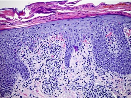 Histopathology showing mild acanthosis, vacuolization o | Open-i