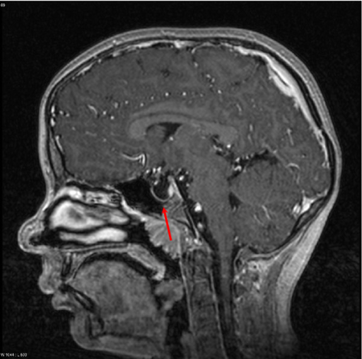 empty-sella-mri-scan-of-the-brain-sagittal-t2-weight-open-i