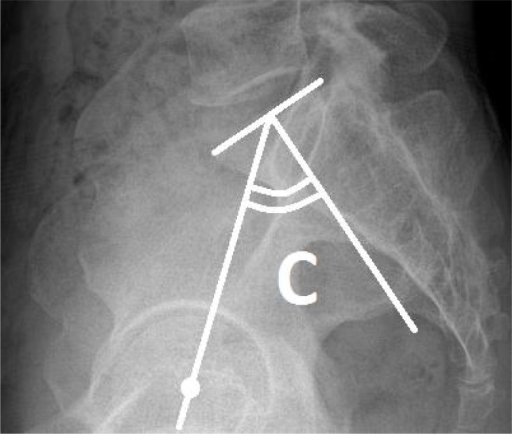 C angle shows pelvic incidence. Following Legaye's desc | Open-i