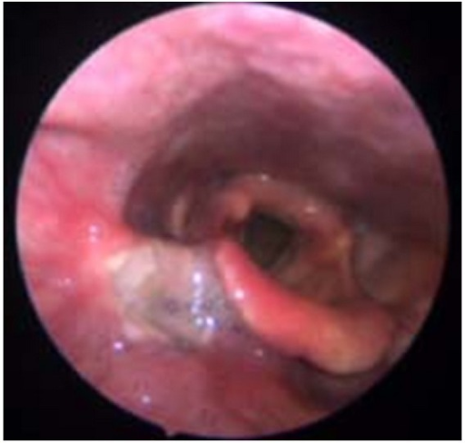 Endoscopic view evidences an ulcerative lesion on the r | Open-i
