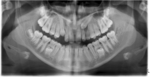 Panoramic image showing unilateral impacted canine in m | Open-i