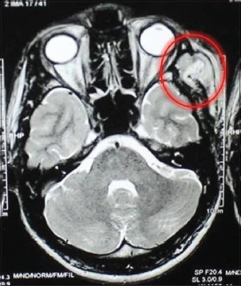 MRI showing a hematoma-like lesion within the temporalis muscle